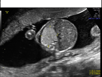 Bronchopulmonary sequestration axial